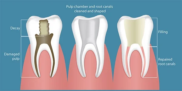 Root canal illustration