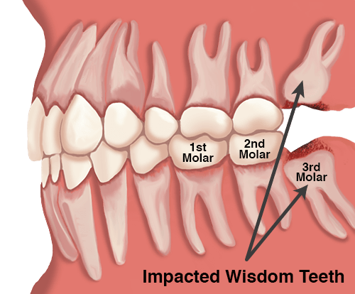 Wisdom teeth illustration