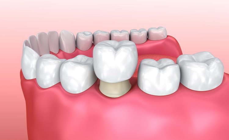 Dental crown illustration