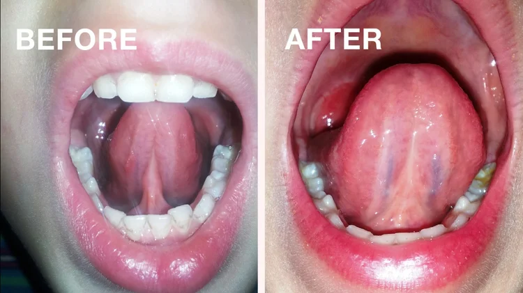 Tongue tie treatment