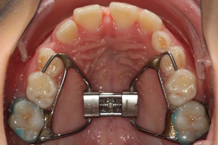 Palate expander appliance