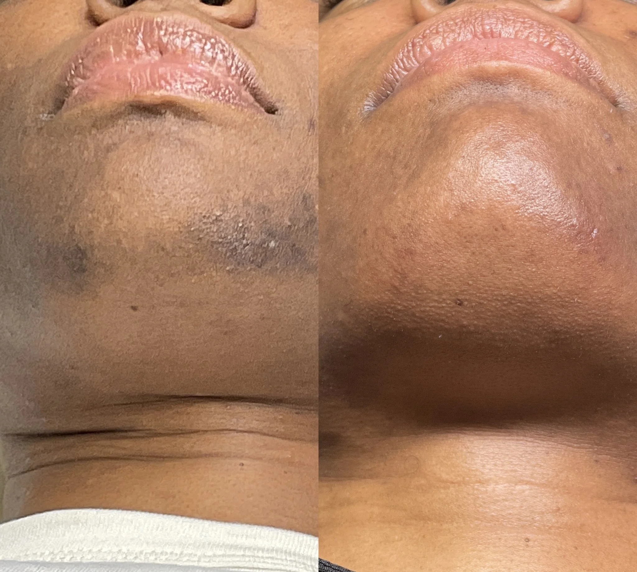 How Many Laser Hair Removal Sessions Do You Really Need?