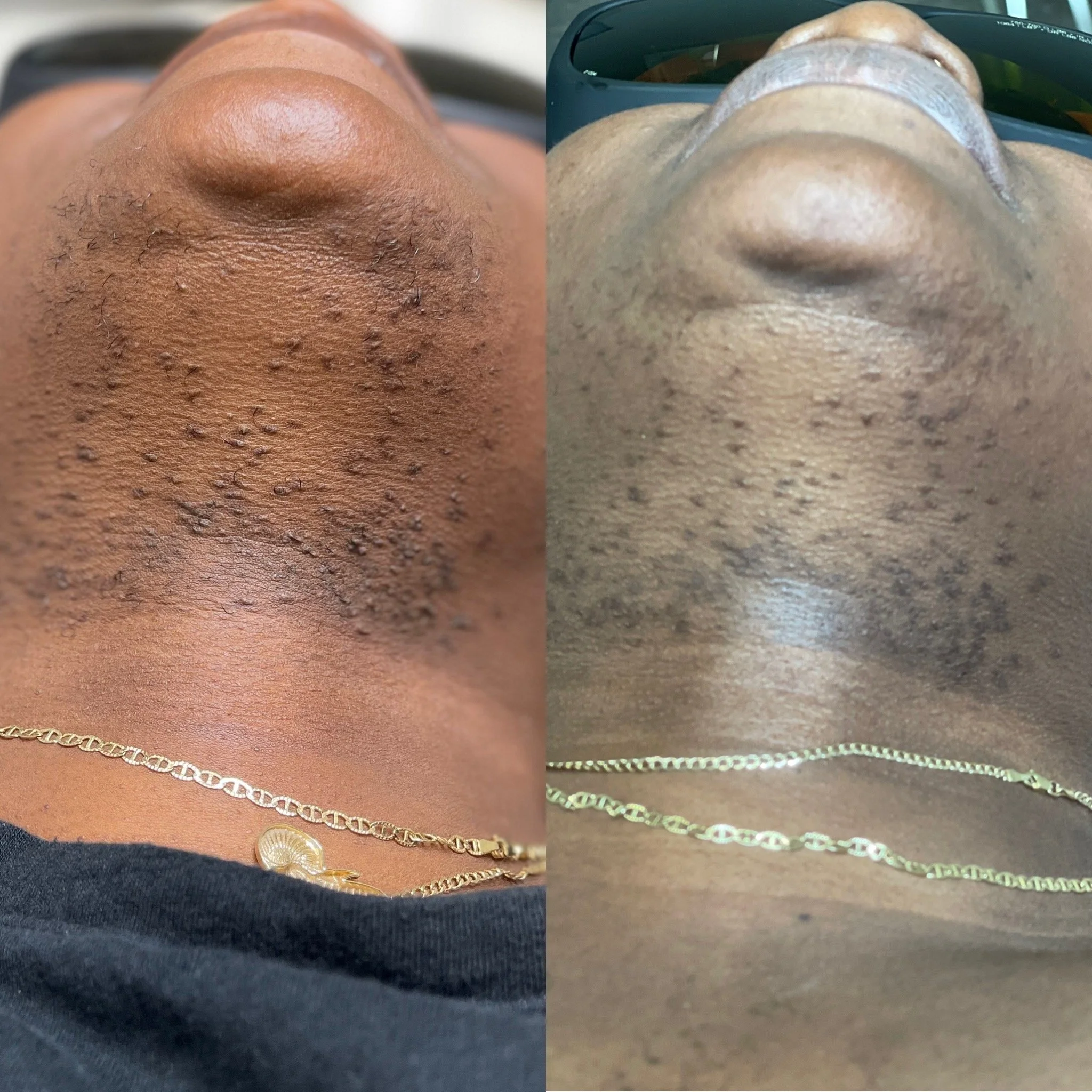 Laser Hair Removal vs. Traditional Hair Removal Methods: What Actually Works Long-Term