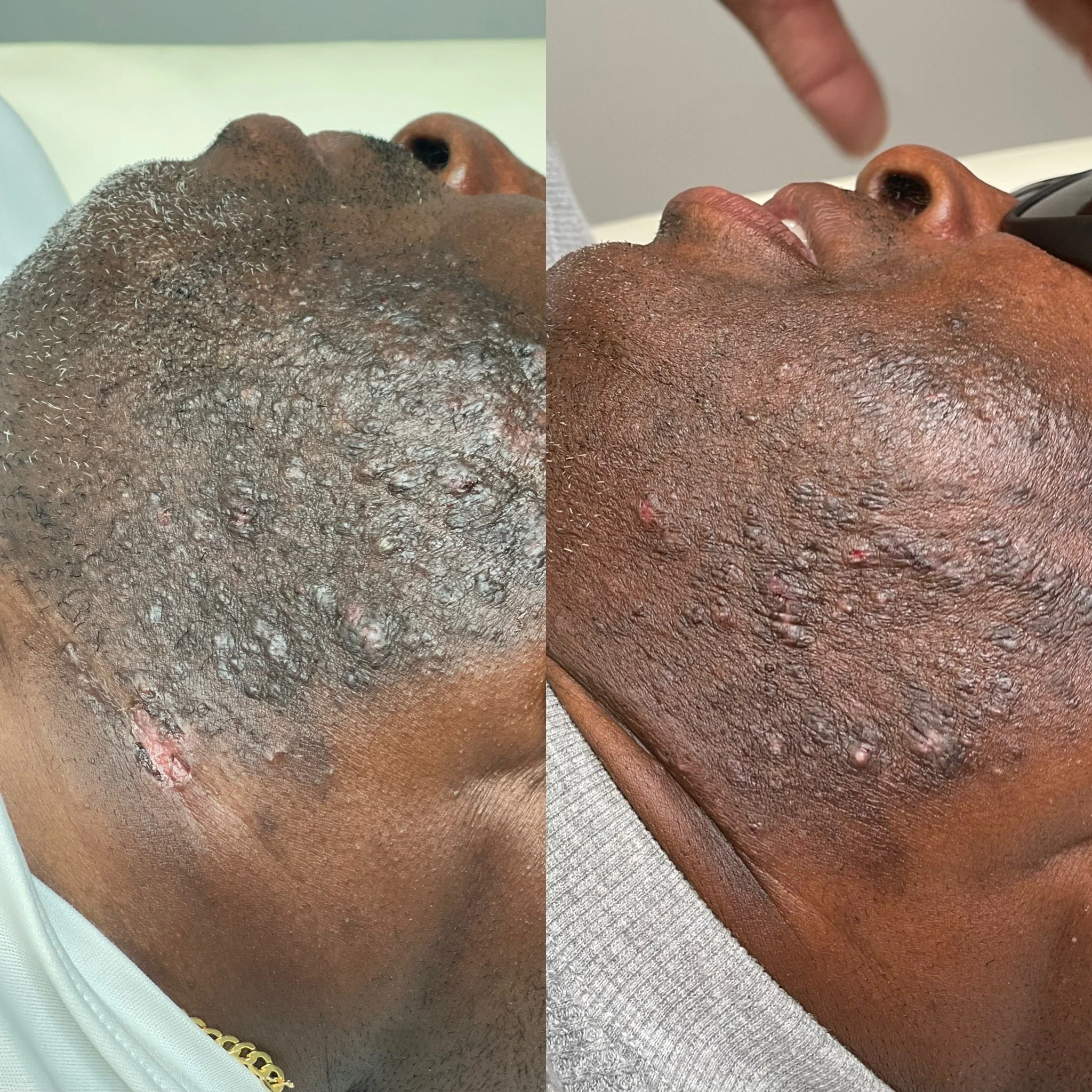 How to Treat Hyperpigmentation After Laser Hair Removal