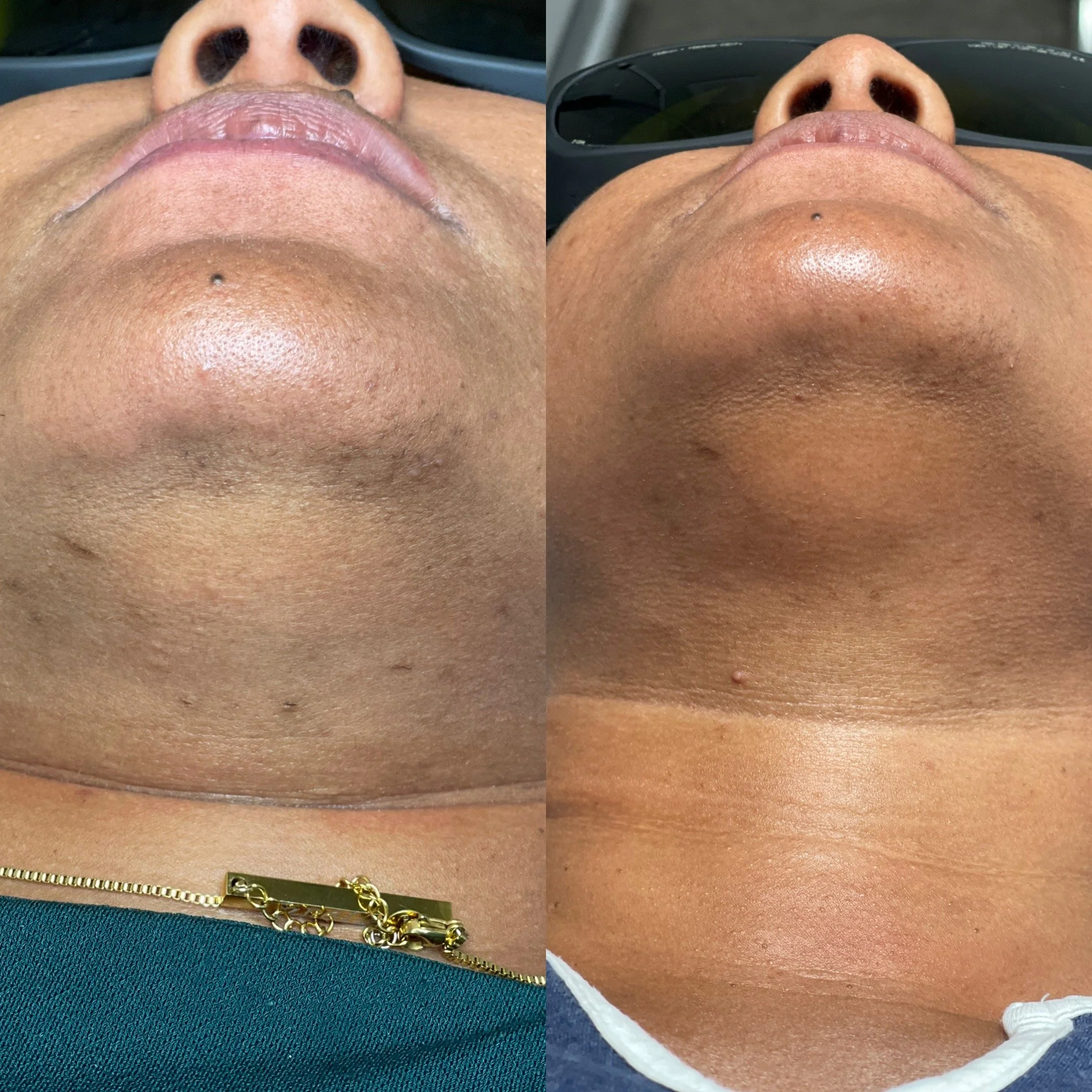 Laser Hair Removal vs. Electrolysis: What's the Difference?