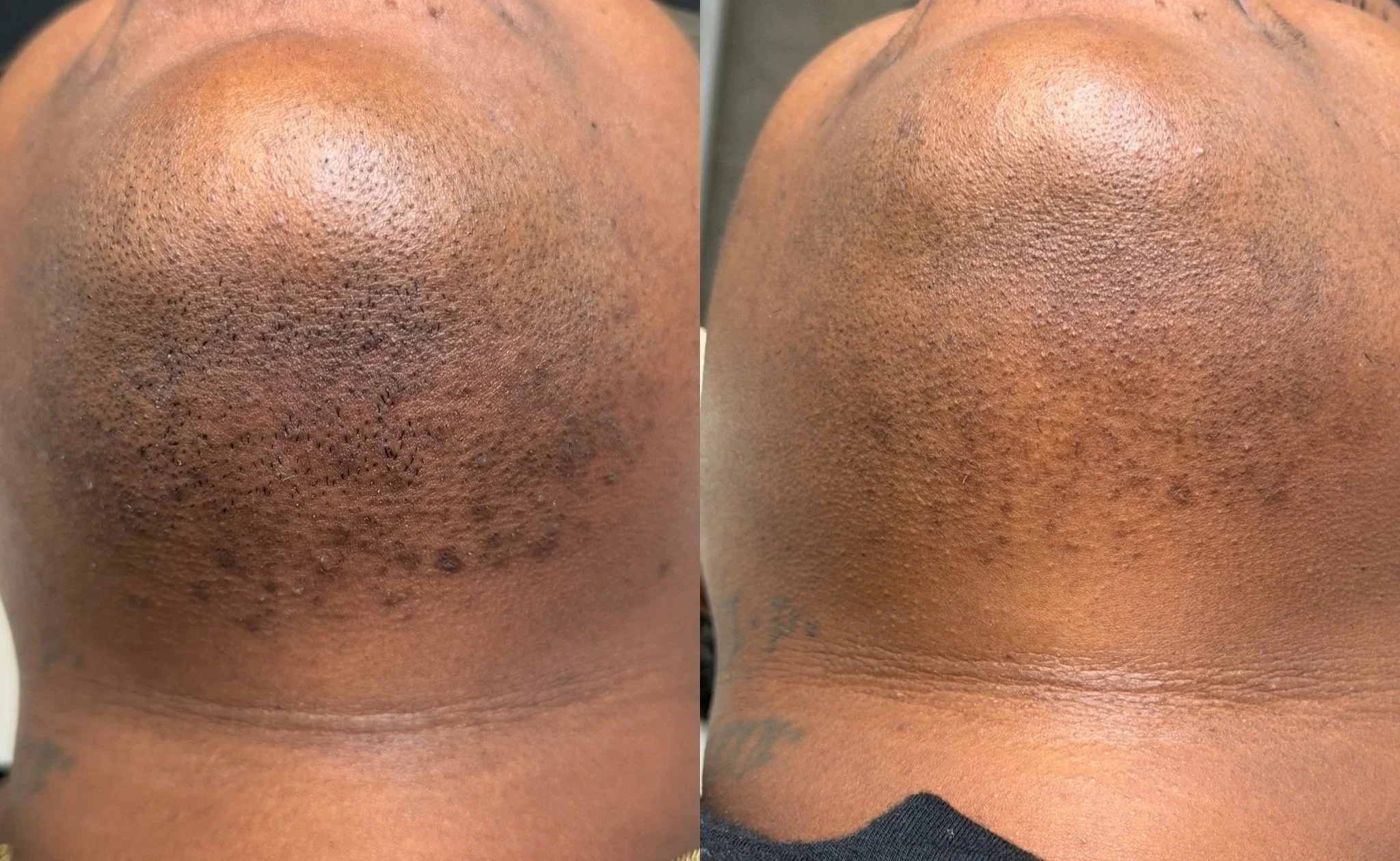 Laser hair removal tampa on dark skin