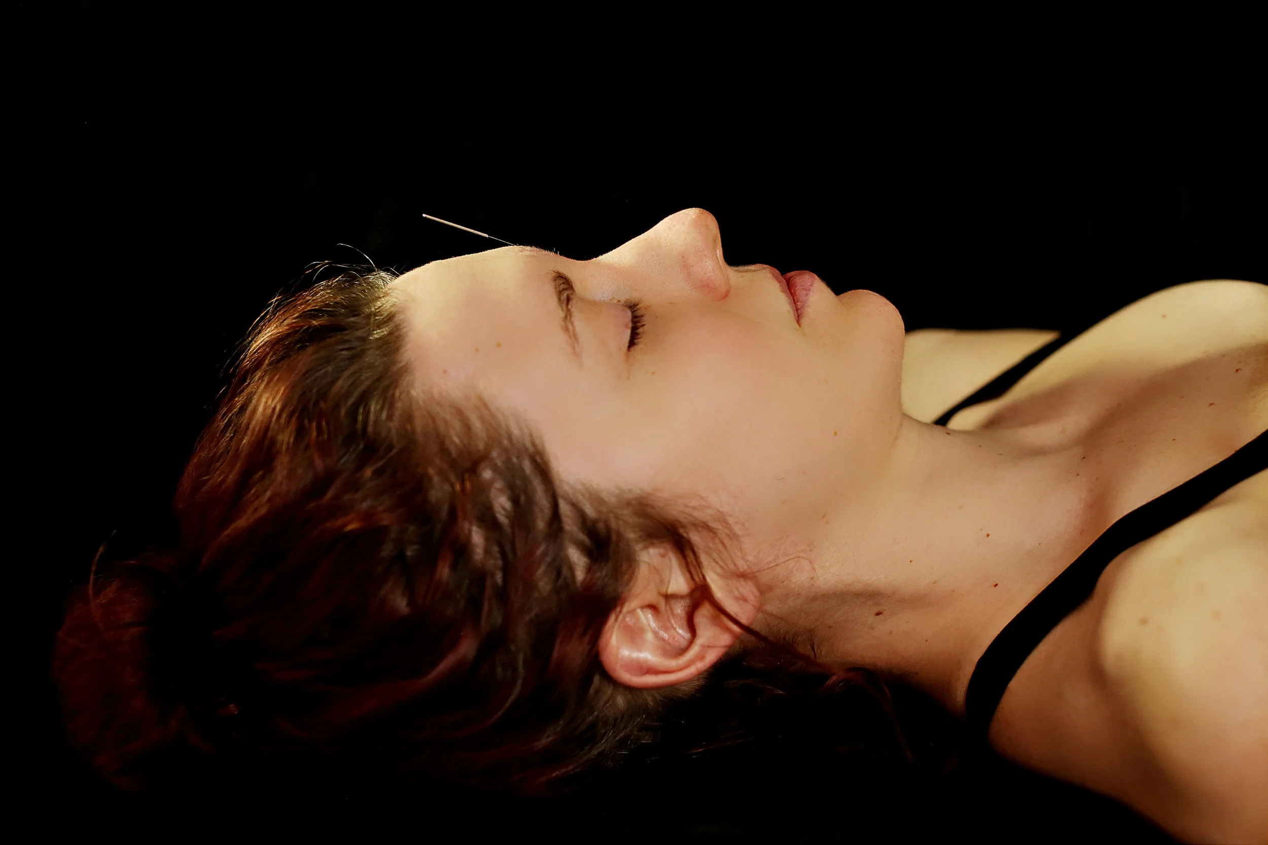 Needle Stimulation in Neuro Enhancing Acupuncture