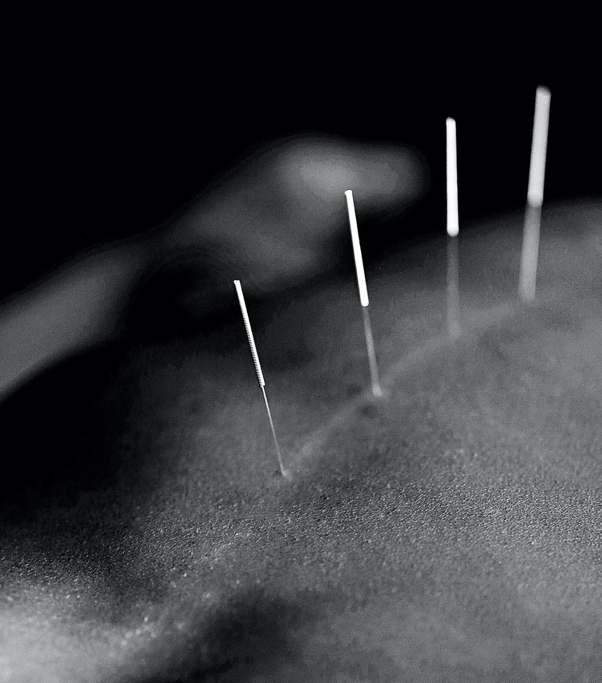 What is Dry Needling? - Sports Acupuncture vs. Dry Needling