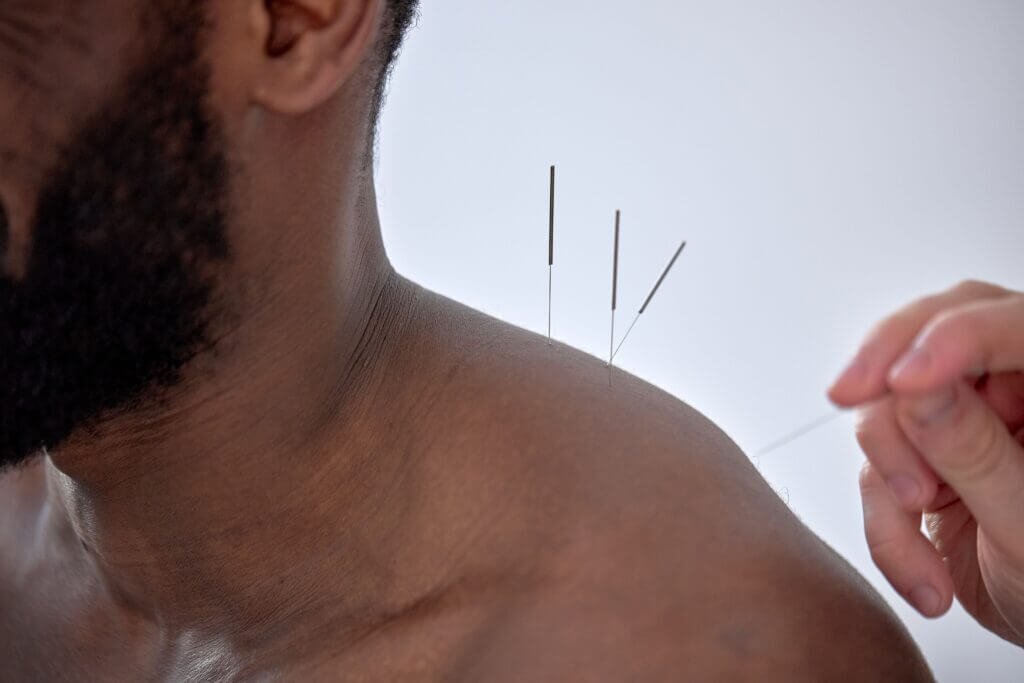 Acupuncture Points: 7 Powerful Spots Every Athlete Should Know
