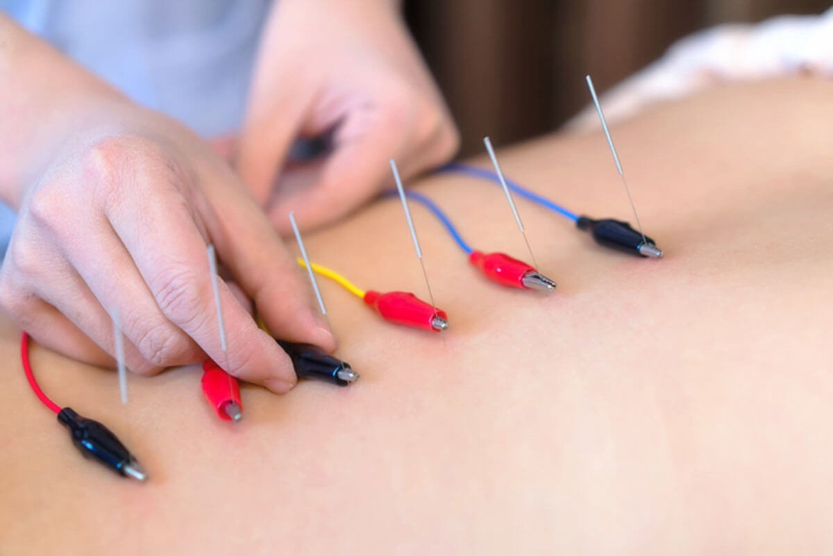 Pain Management With Acupuncture: A Natural Approach to Relief and Recovery