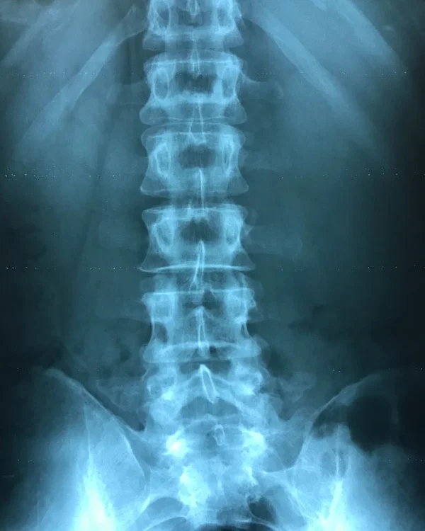 Spinal-Xray-photo.jpg