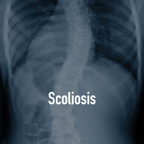 Testimonials-Scoliosis.jpg