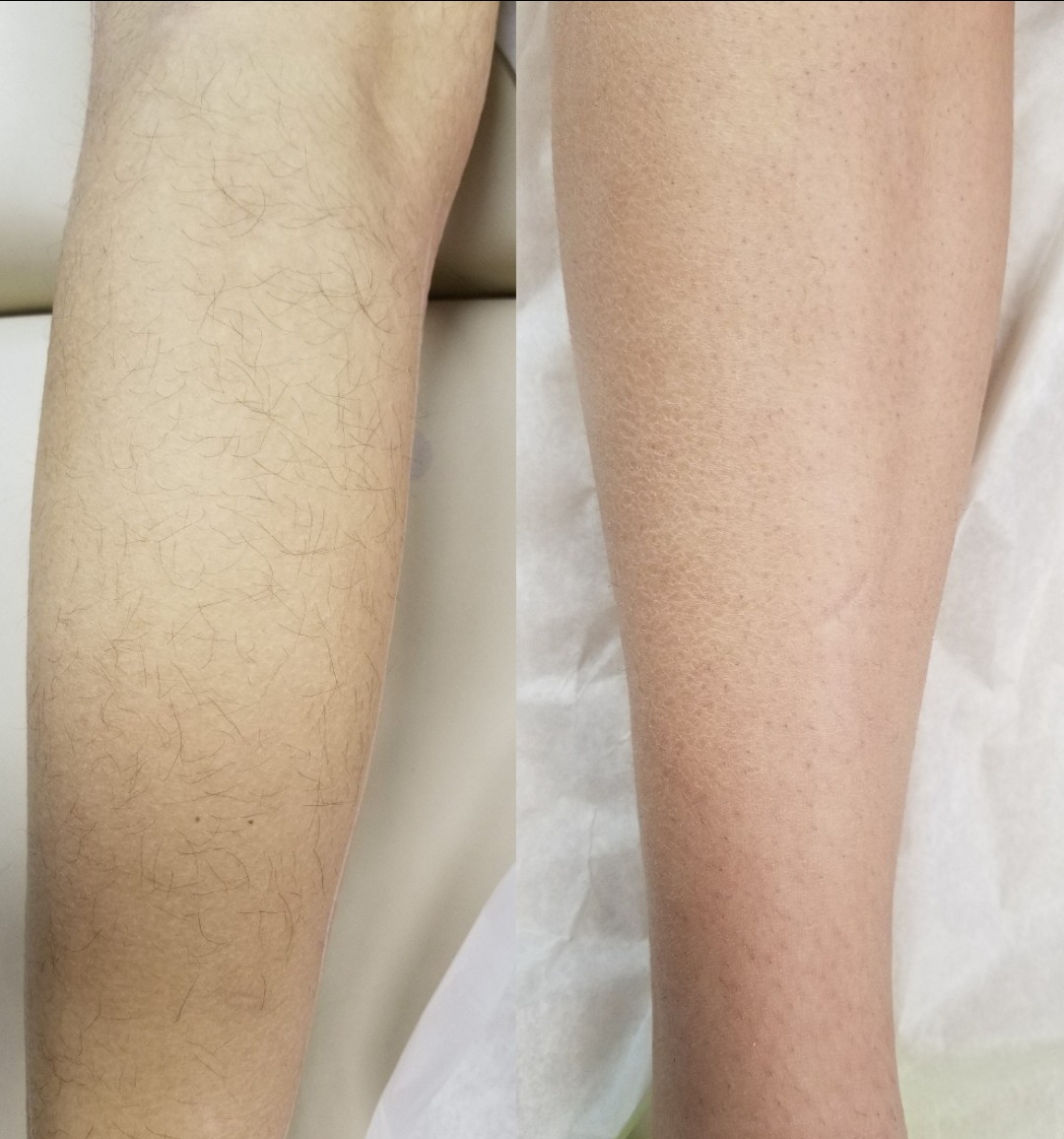 LASER HAIR REMOVAL — ALL IN ONE LASER