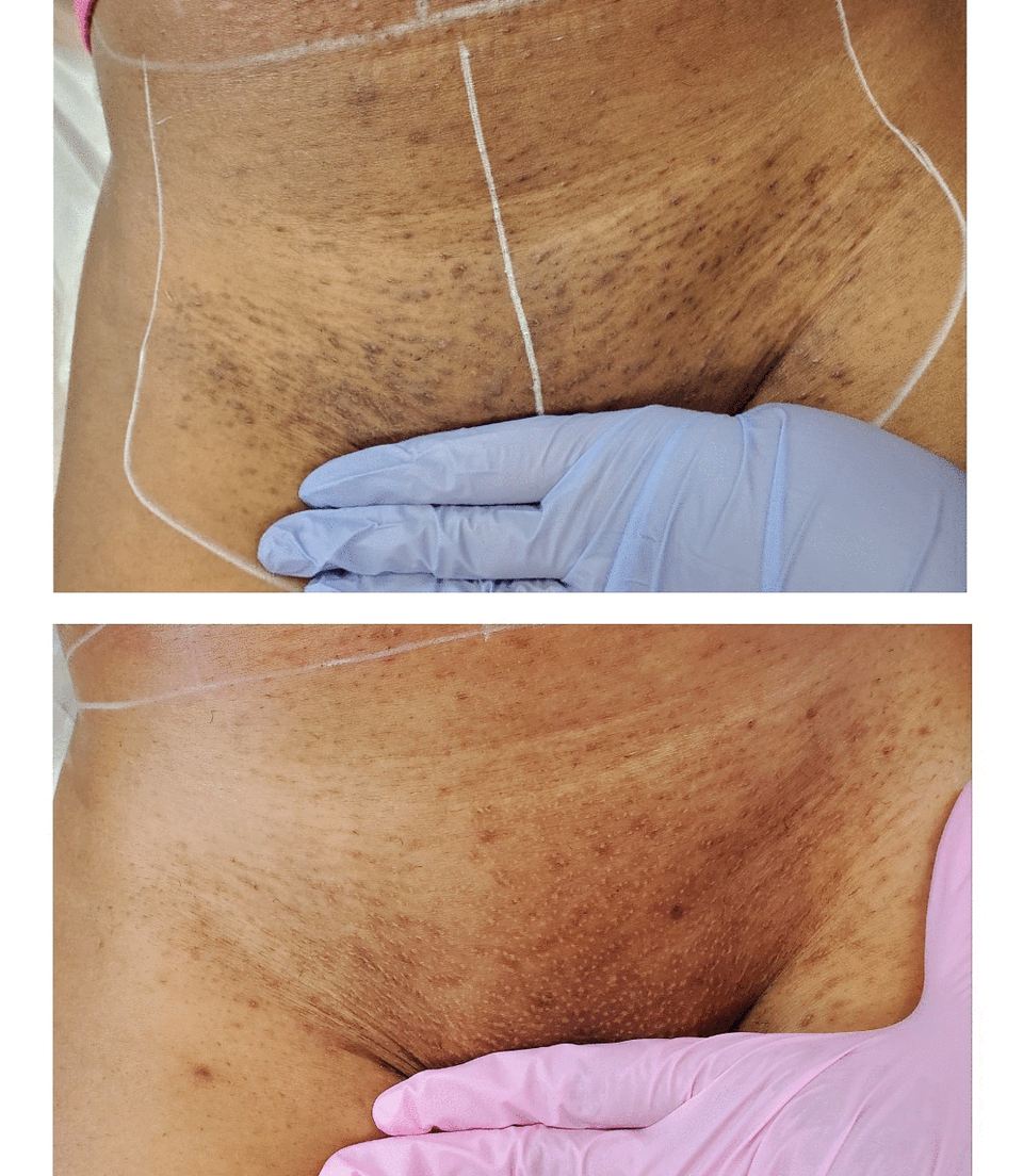 LASER HAIR REMOVAL — ALL IN ONE LASER