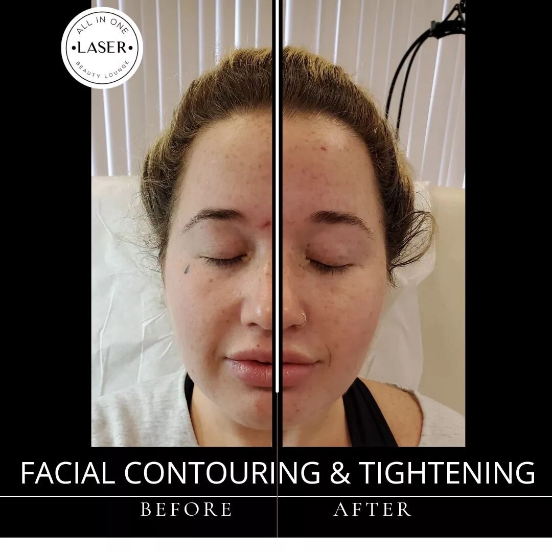 Another awesome lift and contour transformation 🔥
Results are immediate 👌
This treatment is a non surgical and non invasive treatment resulting in no downtime, you can return to your daily activities immediately following treatment
DM us for your a