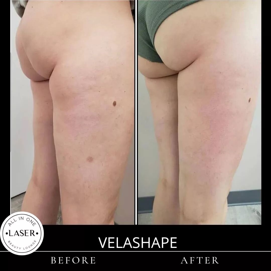 Okkk how amazing is this transformation!!! Results achieved only after 1 treatment of VelaShape!! Cellulite reduction and butt lifted! Client will have 4 treatments in total for optimal results 💗
DM us for an appointment
.
📞617-393-3456
🌏www.myall