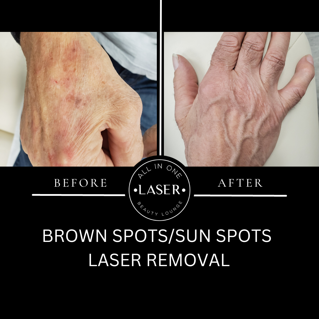LASER BROWN SPOT REMOVAL — ALL IN ONE LASER