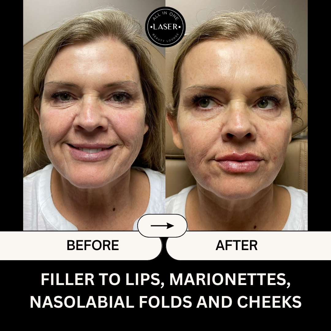 FILLER TO LIPS, MARIONETTES, NASOLABIAL FOLDS AND CHEEKS.png