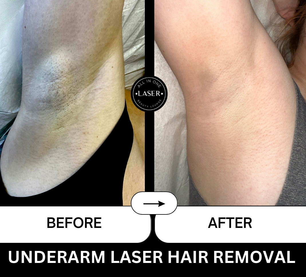 UNDERARM LASER HAIR REMOVAL.png