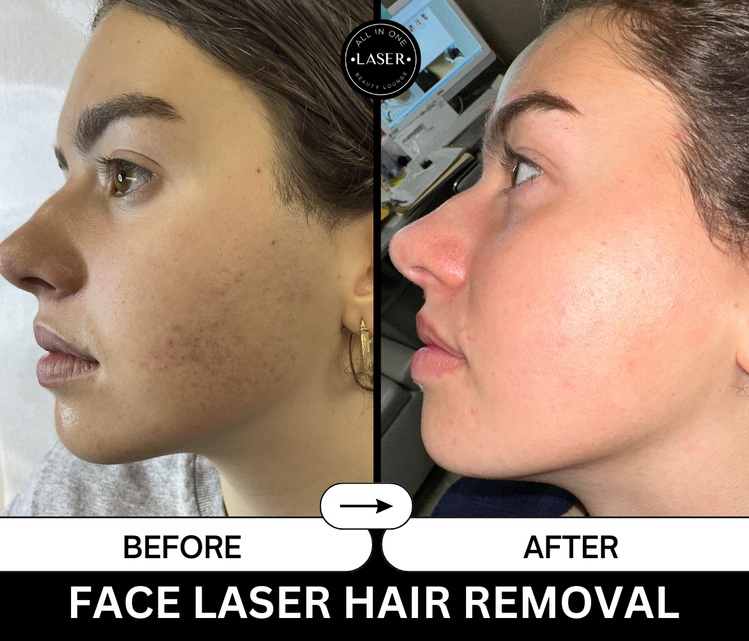 FACE LASER HAIR REMOVAL.png