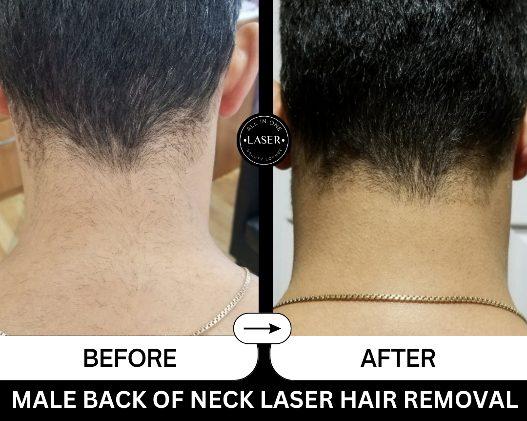 MALE BACK OF NECK LASER HAIR REMOVAL.png