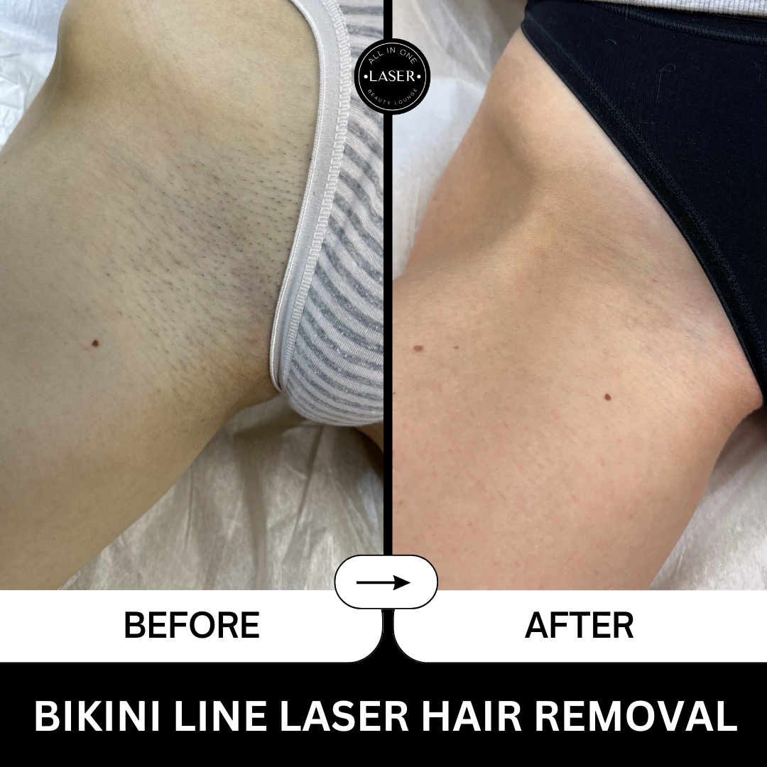 BIKINI LINE LASER HAIR REMOVAL (1).png