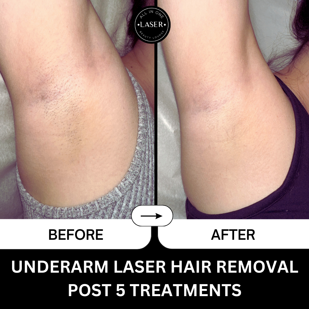 UNDERARM LASER HAIR REMOVAL POST 5 TREATMENTS.png