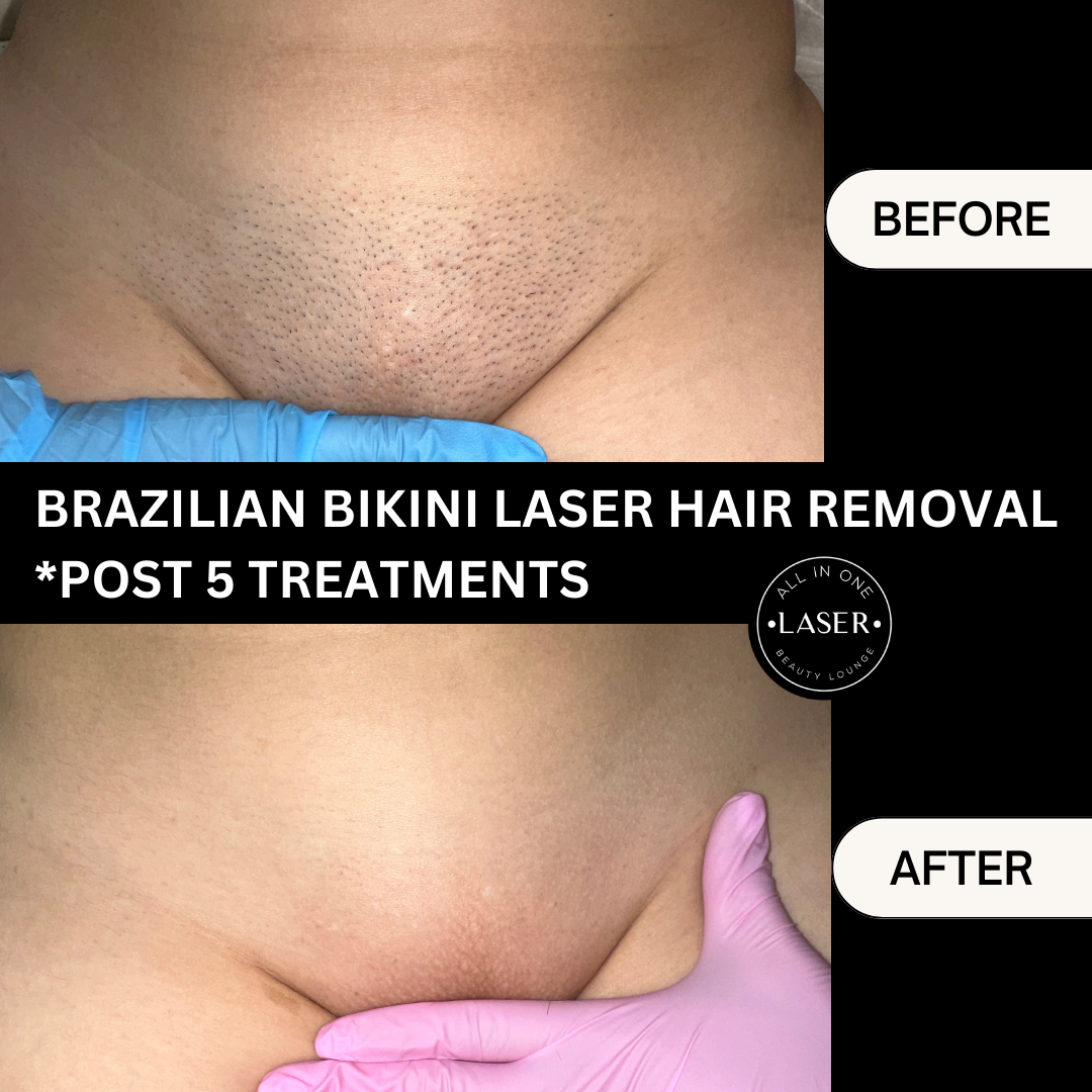 BRAZILIAN BIKINI LASER HAIR REMO.png