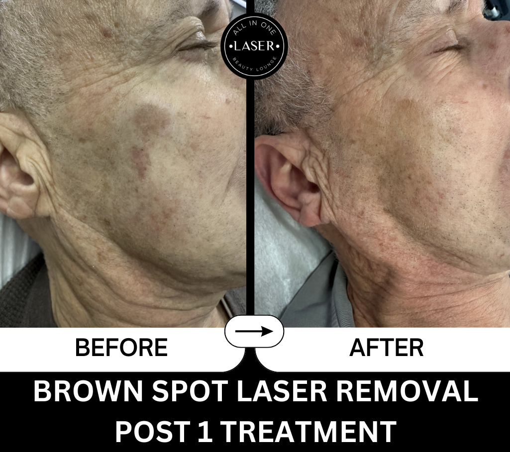 BROWN SPOT LASER REMOVAL POST 1 TREATMENT.png