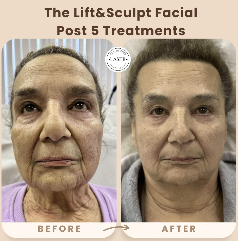 Copy of SUN SPOT REMOVAL POST 1 TREATMENT.png
