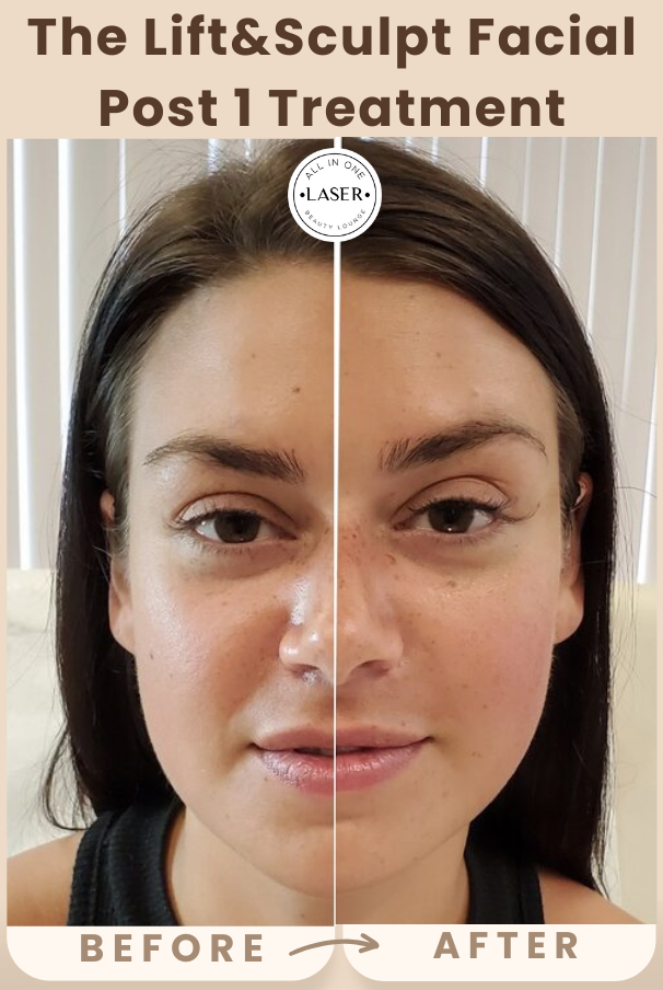 Copy of Copy of SUN SPOT REMOVAL POST 1 TREATMENT(4).png
