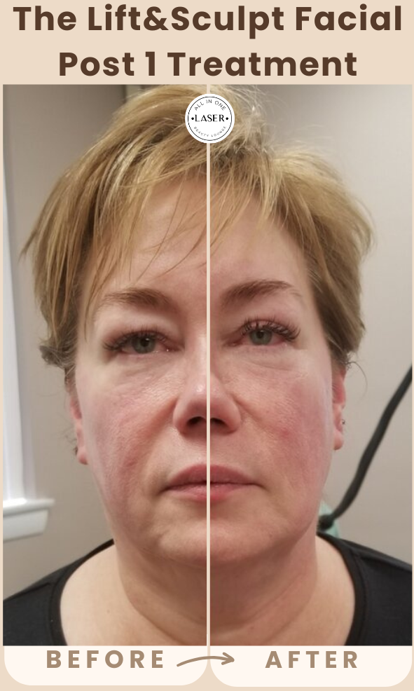 Copy of Copy of Copy of SUN SPOT REMOVAL POST 1 TREATMENT.png