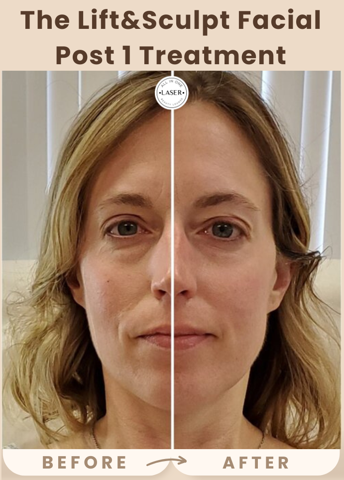 Copy of Copy of SUN SPOT REMOVAL POST 1 TREATMENT(5).png