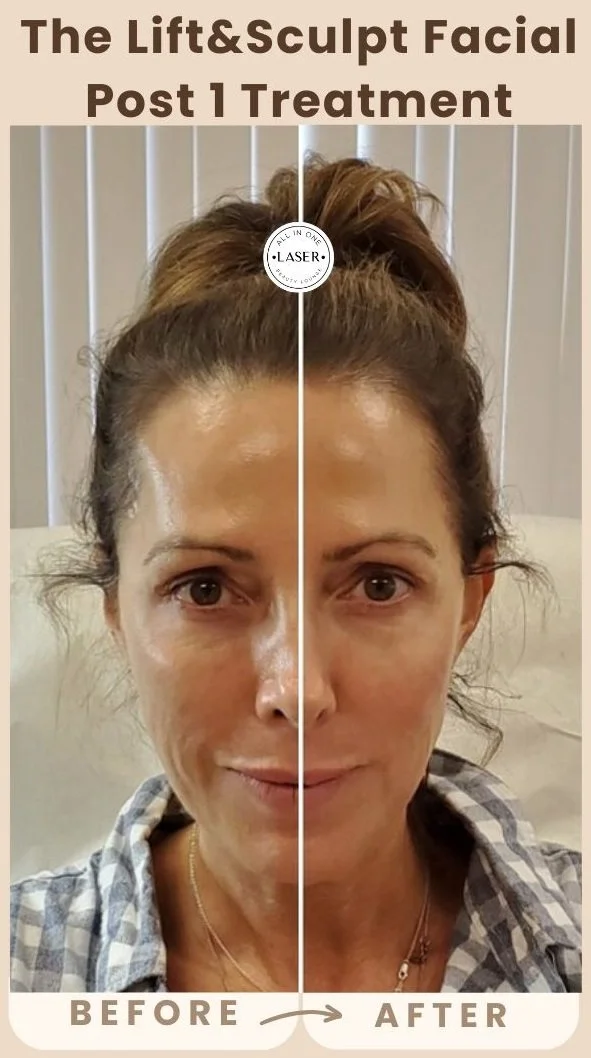 Copy of Copy of Copy of Copy of SUN SPOT REMOVAL POST 1 TREATMENT (2).jpg