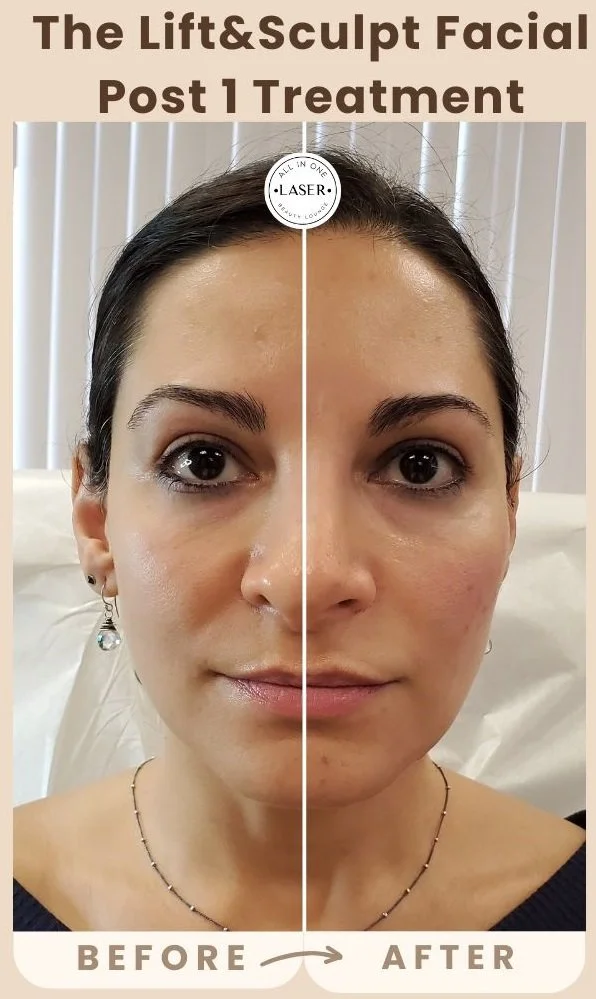 Copy of Copy of Copy of Copy of Copy of SUN SPOT REMOVAL POST 1 TREATMENT (1).jpg
