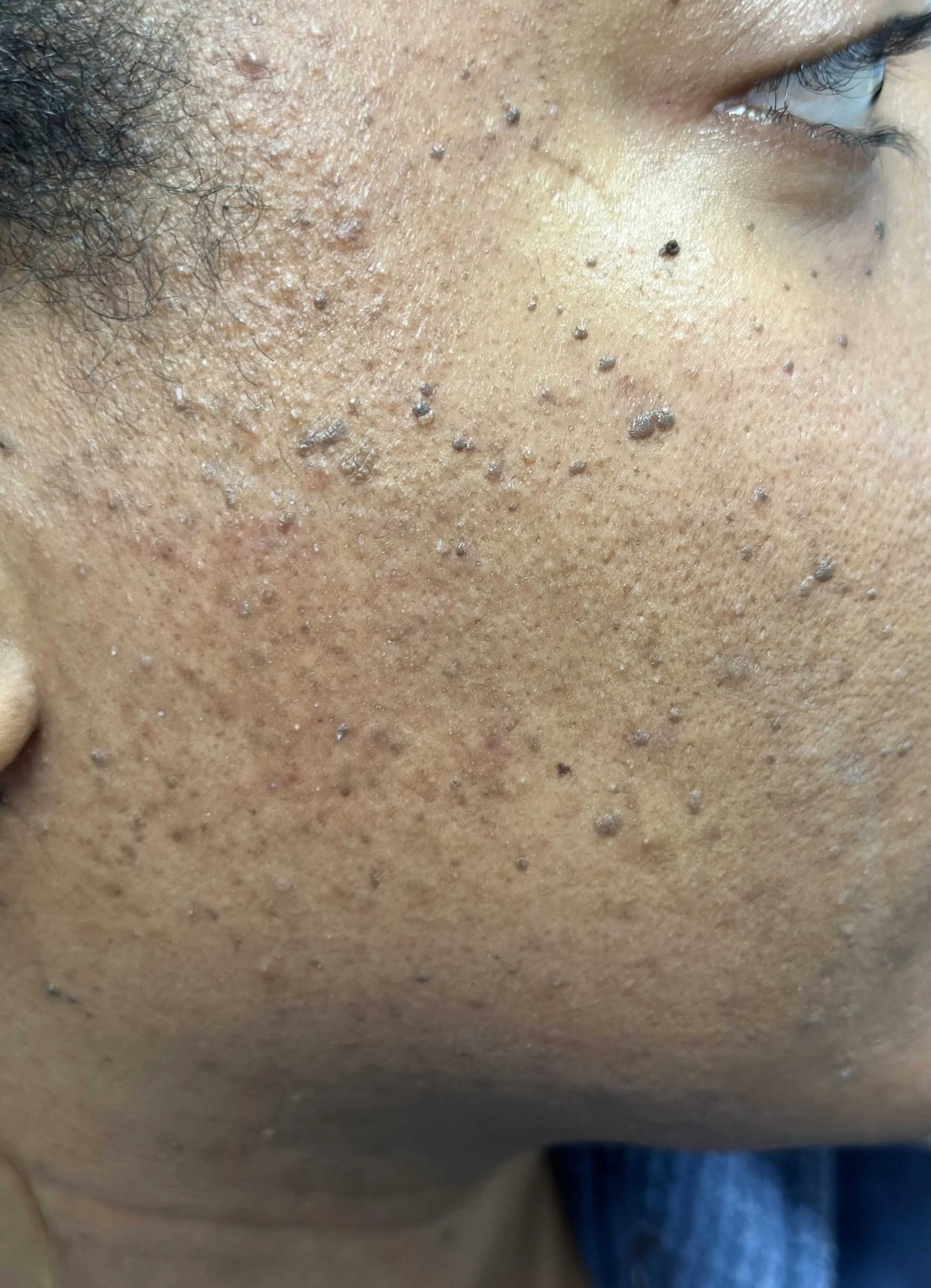 Irregular Skin SKIN IRREGULARITIES — ALL IN ONE LASER