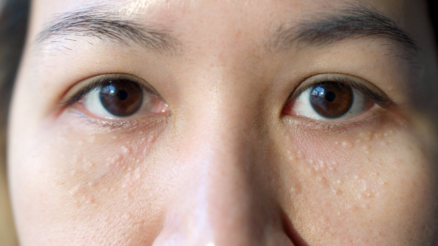 SKIN IRREGULARITIES — ALL IN ONE LASER