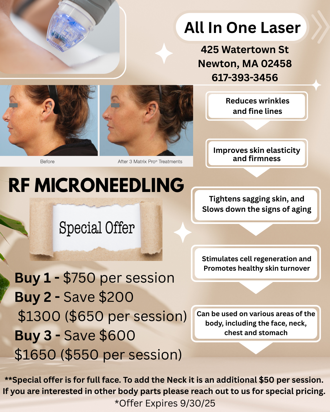 Rf Microneeding, microneedling