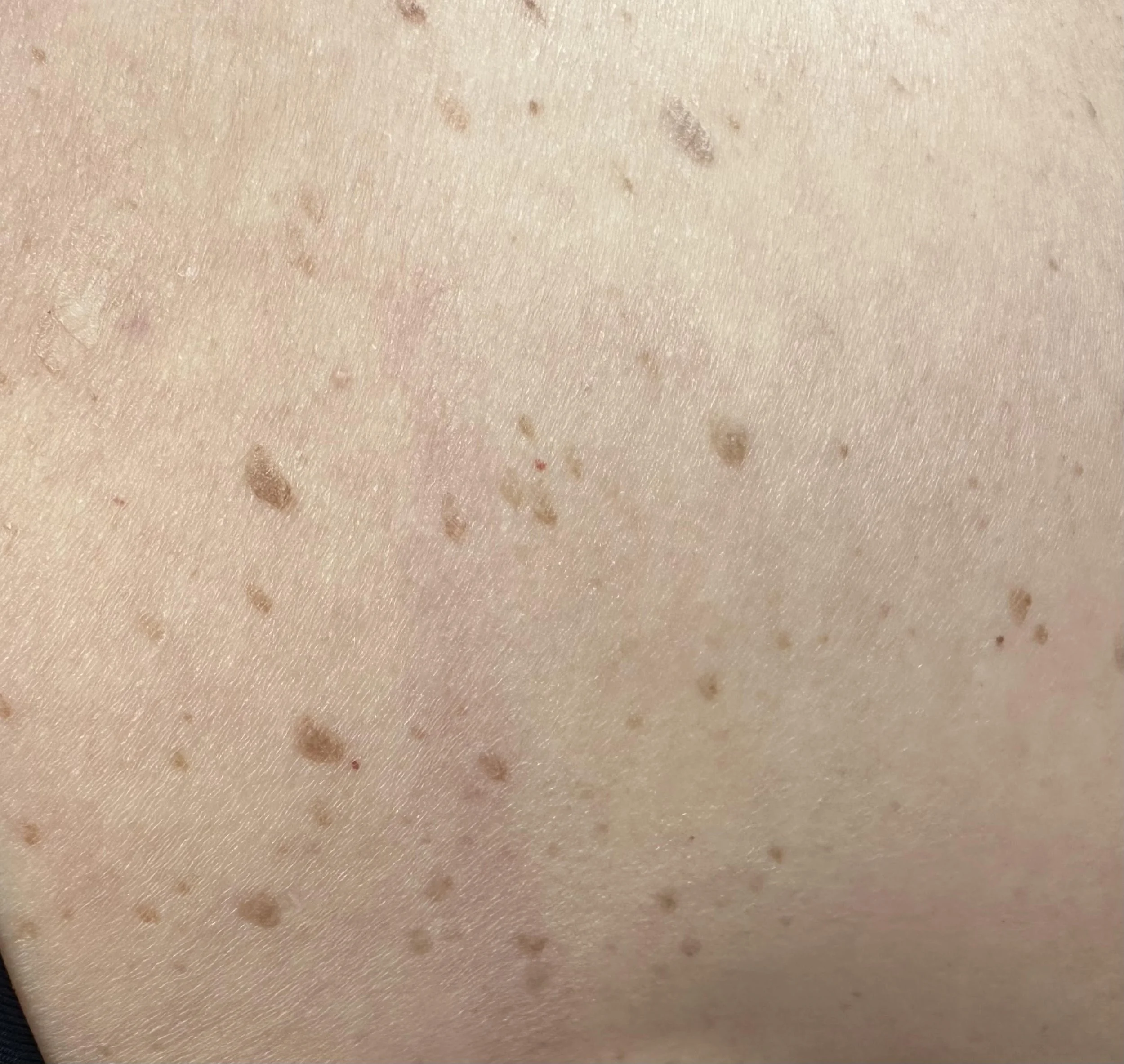 SKIN IRREGULARITIES — ALL IN ONE LASER