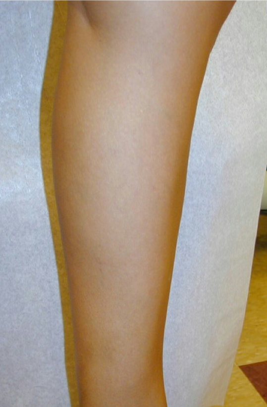 Varicose Veins (D) After