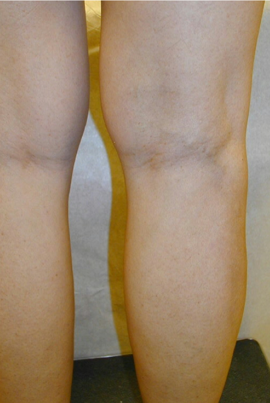 Varicose Veins (C) After