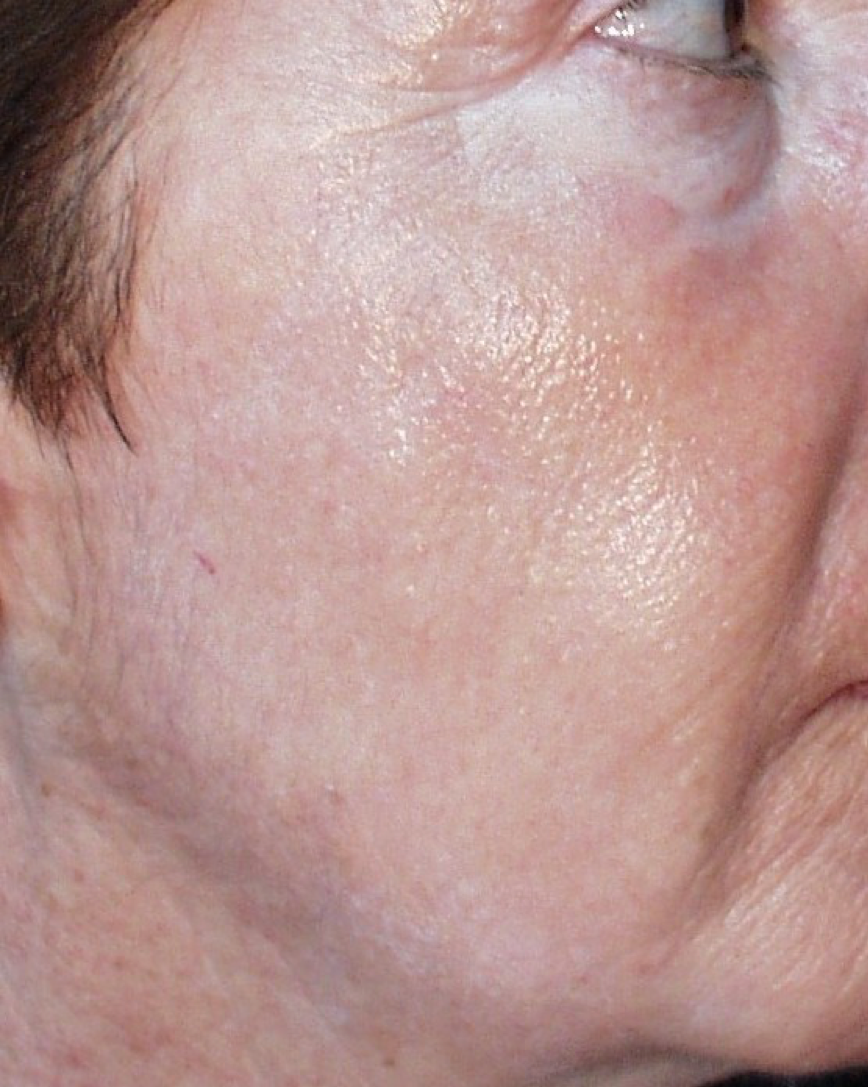 Wrinkles (Female) After.png
