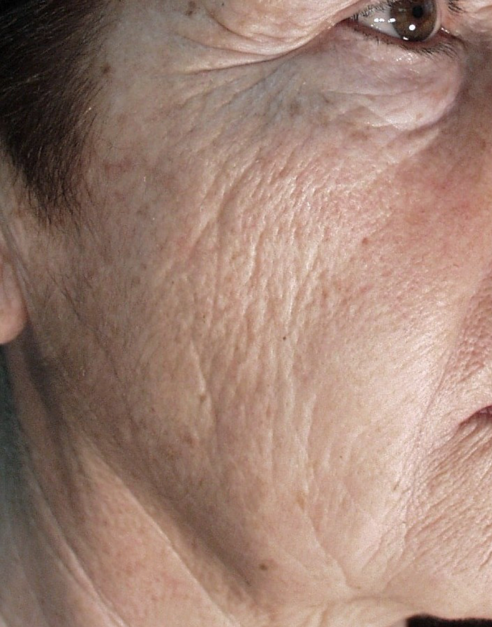 Wrinkles (Female) Before.png