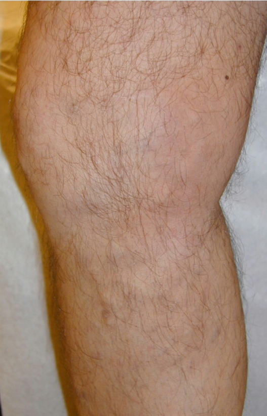 Varicose Veins (A) After