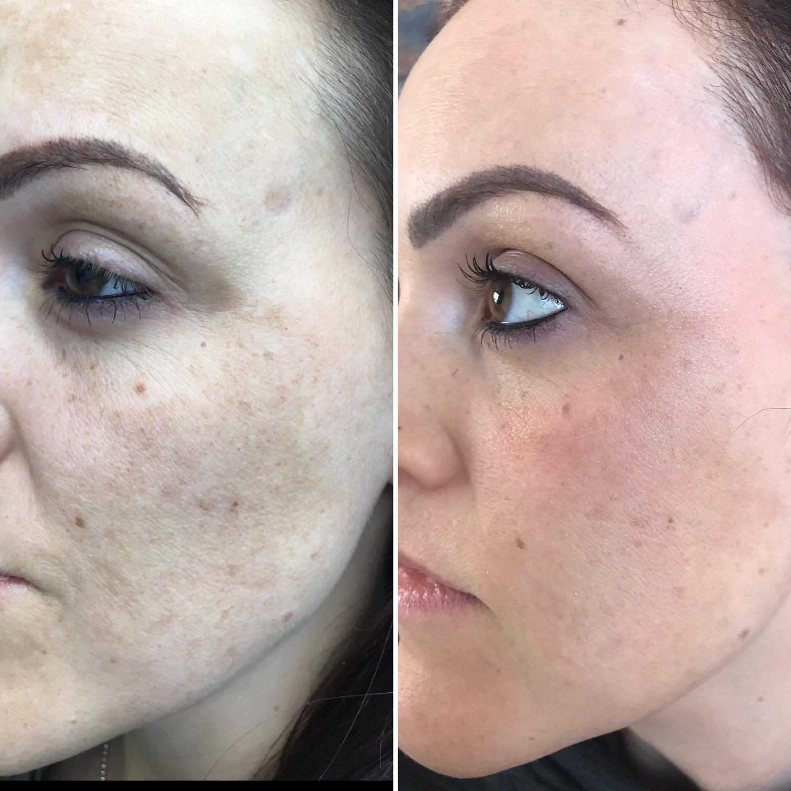 Sample treatment - non surgical platelet rich plasma before and after (Copy)