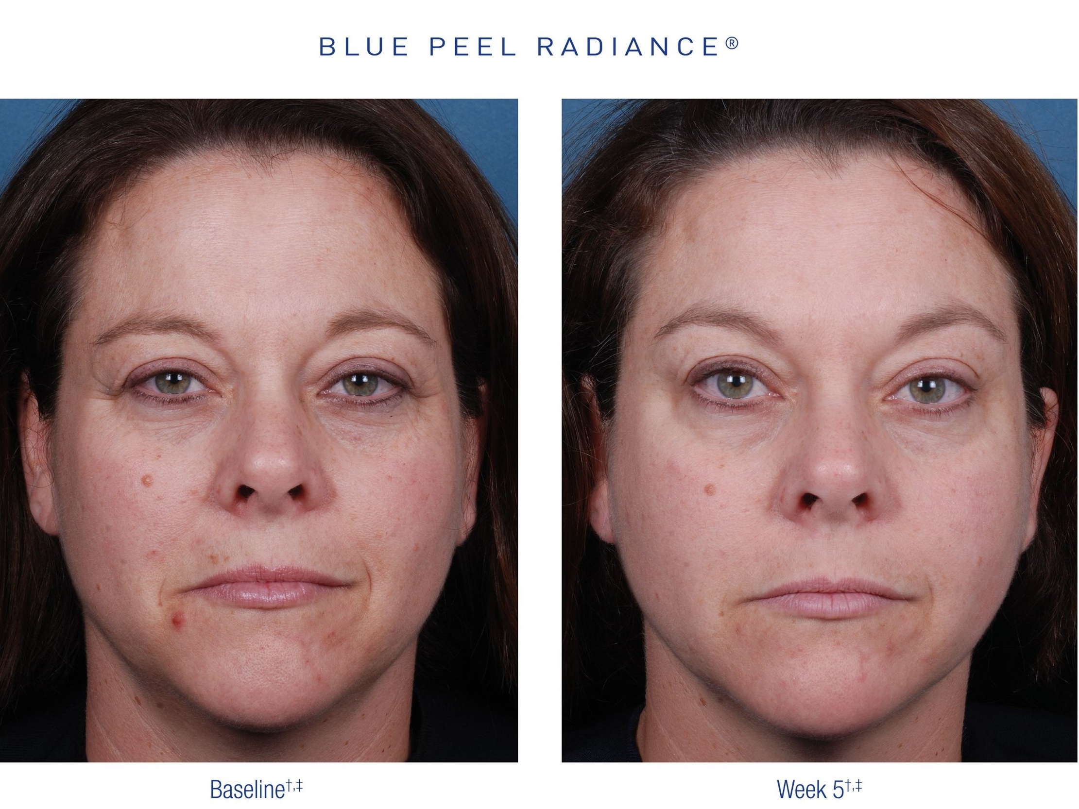 CHEMICALPEEL_BLUEPEEL_OBAGI_Before&After2.png.jpg