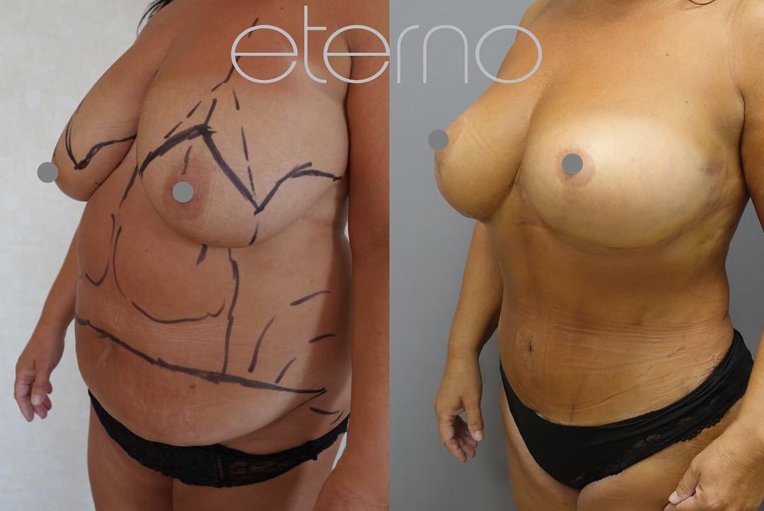 Breast reduction, augmentation, liposuction and tummy tuck.jpg