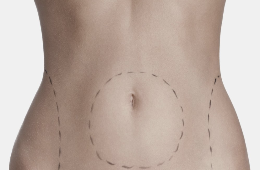 Is Tummy Tuck Surgery Right for Me?