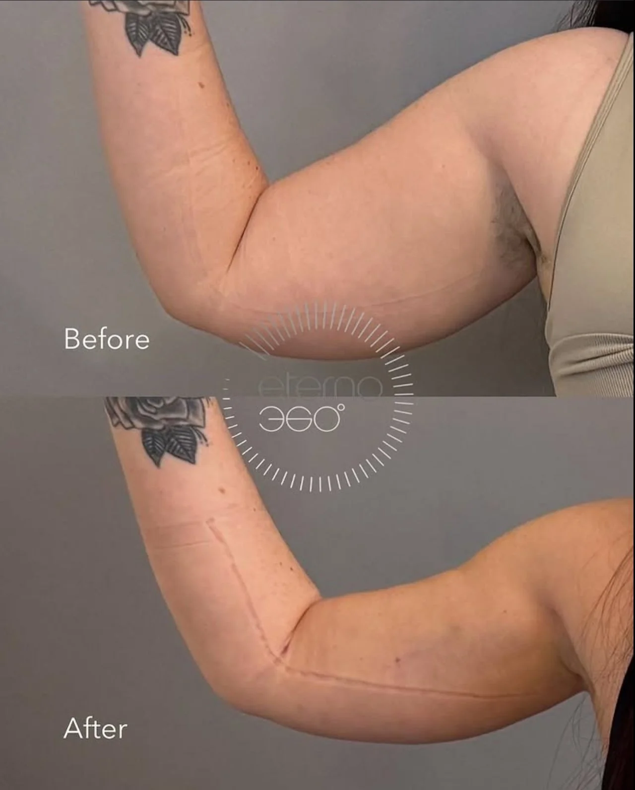 Say Goodbye to Arm Sagging Without the Long Scar: The New Way to Sculpt Sleeker Arms