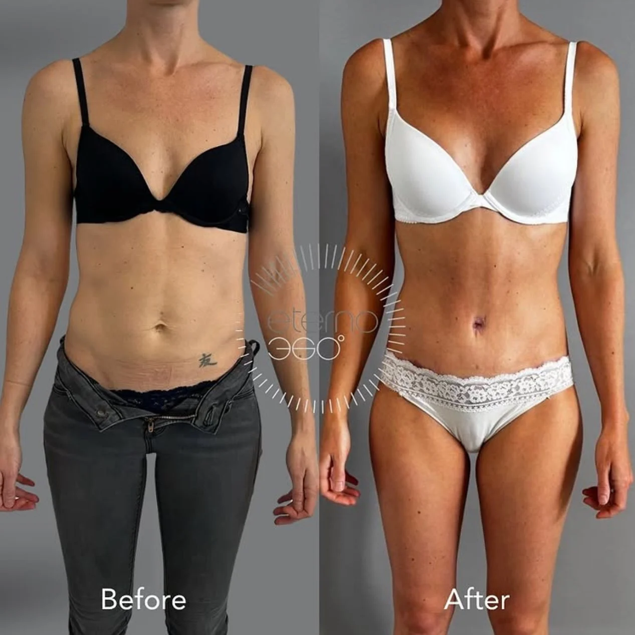 Tummy Tucks After Pregnancy: Why Slim Women Struggle Too  -  And How Surgery Can Help